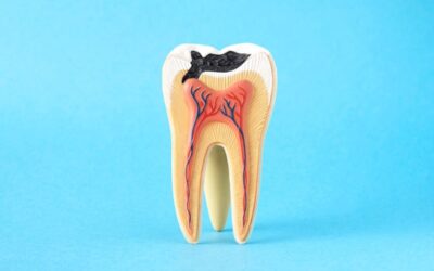 Can a Cavity Be Removed by Brushing? A Pediatric Dentist Explains