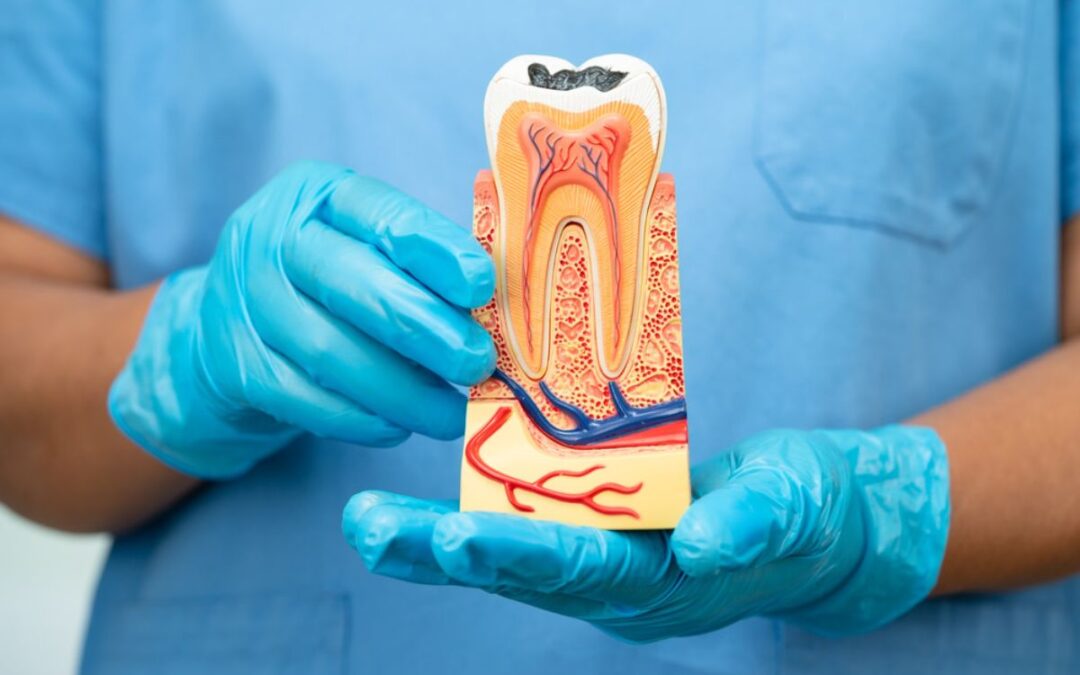 Root Canal Therapy