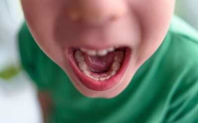 Shark Teeth in Kids: What Parents Need to Know