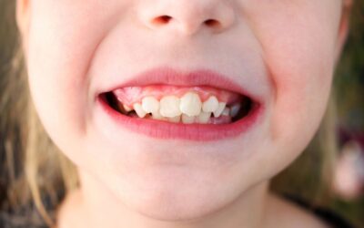 Baby Teeth Won’t Fall Out: What to Do
