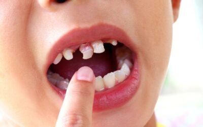 Causes of Tooth Decay in Kids?