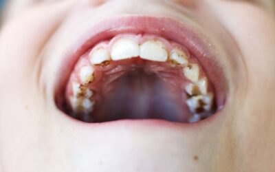 Cavities in Children: Causes, Symptoms, and Prevention