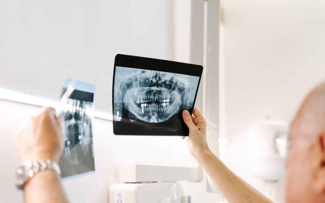 Are Dental X-Rays Safe for Kids? What Parents Should Know
