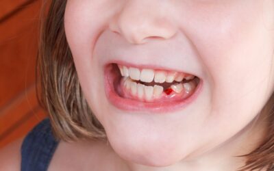 Baby Tooth Knocked Out? What Parents Should Do Immediately