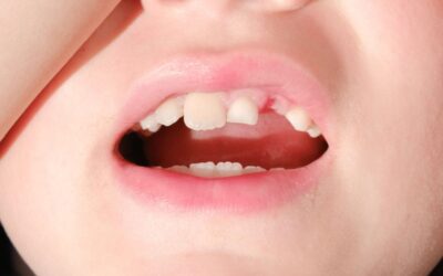 Dental Emergencies in Children: What Parents Should Do Immediately