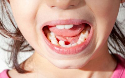What Happens If Baby Teeth Are Lost Too Early?