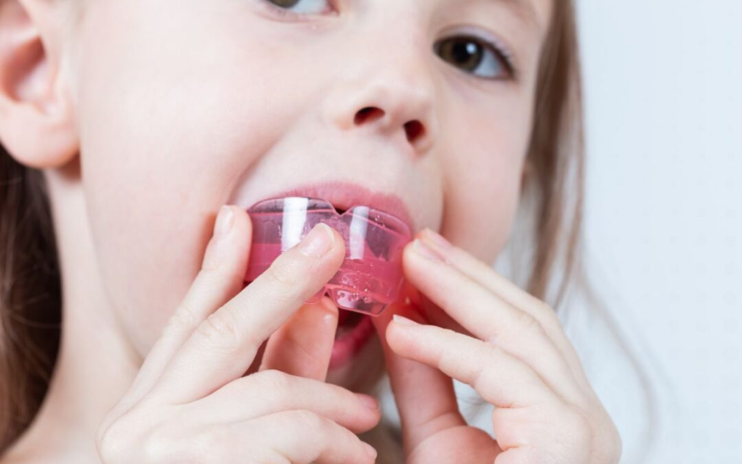 Why Mouthguards Matter More Than You Think