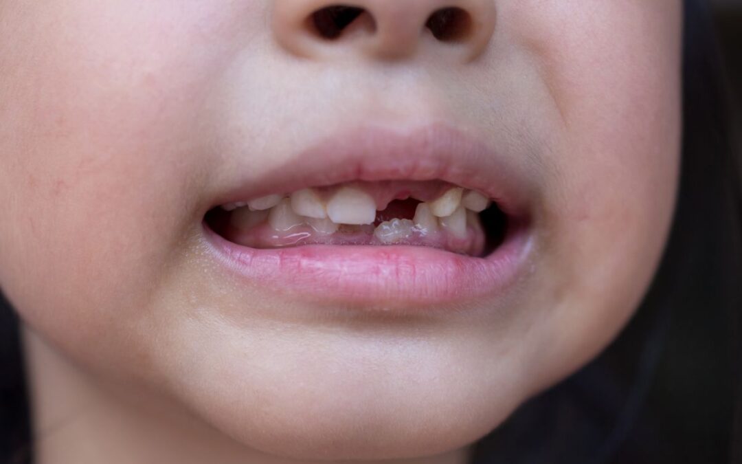 What to Do If Your Child Chips or Breaks a Tooth
