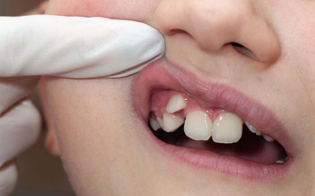 Orthodontic Early Signs in Kids